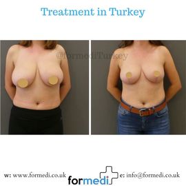 Breast Reduction & Uplift Surgery formedi