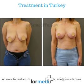 Breast Reduction & Uplift Surgery formedi