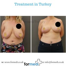 Breast Reduction & Uplift Surgery formedi
