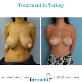 Breast Reduction & Uplift Surgery formedi