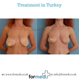 Breast Reduction & Uplift Surgery formedi