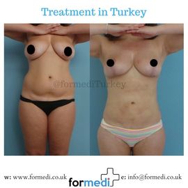 Breast Reduction & Uplift Surgery formedi