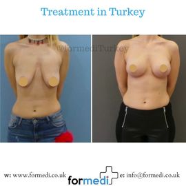 Breast Reduction & Uplift Surgery formedi