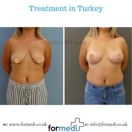 Breast Reduction & Uplift Surgery formedi