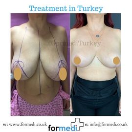 Breast Reduction & Uplift Surgery formedi