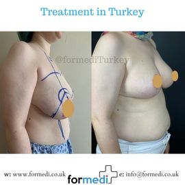 Breast Reduction & Uplift Surgery formedi