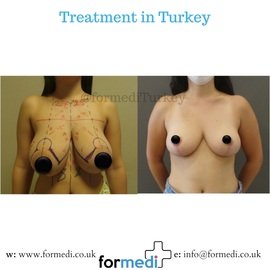 Breast Reduction & Uplift Surgery formedi