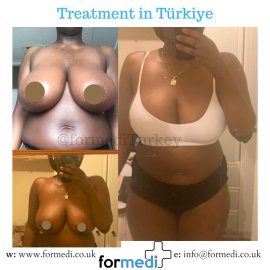 Breast Reduction & Uplift Surgery formedi