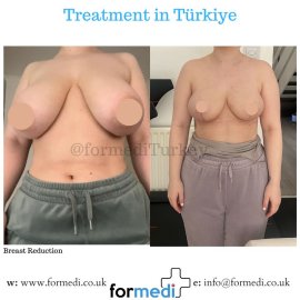 Breast Reduction & Uplift Surgery formedi