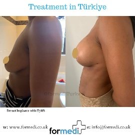Breast Augmentation Turkiye