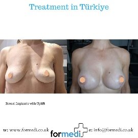 Breast Augmentation Turkiye