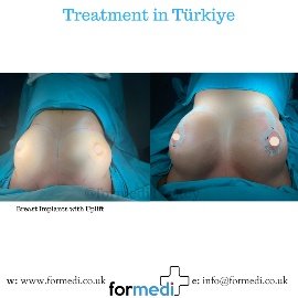 Breast Augmentation Turkiye