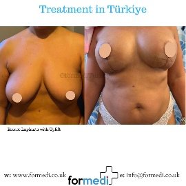 Breast Augmentation Turkiye