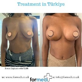 Breast Augmentation Turkiye