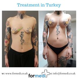 Breast Augmentation Turkiye