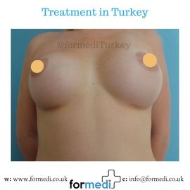 Breast Augmentation Turkiye