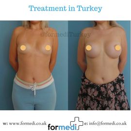 Breast Augmentation Turkiye