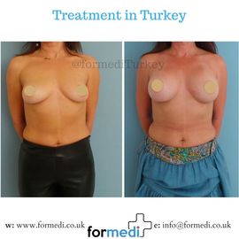 Breast Augmentation Turkiye