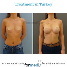 Breast Augmentation Turkiye