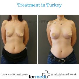 Breast Augmentation Turkiye