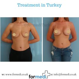 Breast Augmentation Turkiye