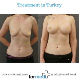 Breast Augmentation Turkiye
