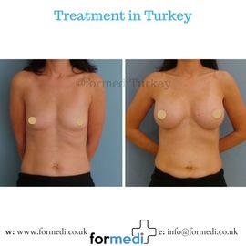 Breast Augmentation Turkiye