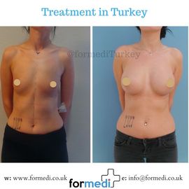 Breast Augmentation Turkiye