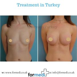 Breast Augmentation Turkiye