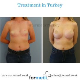 Breast Augmentation Turkiye