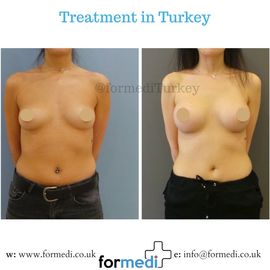 Breast Augmentation Turkiye