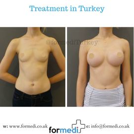 Breast Augmentation Turkiye