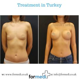 Breast Augmentation Turkiye