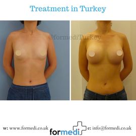 Breast Augmentation Turkiye