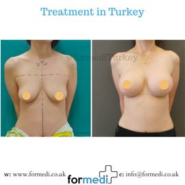Breast Augmentation Turkiye