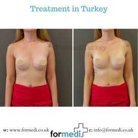 Breast Augmentation Turkiye