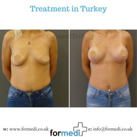 Breast Augmentation Turkiye