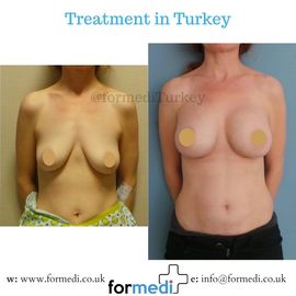 Breast Augmentation Turkiye