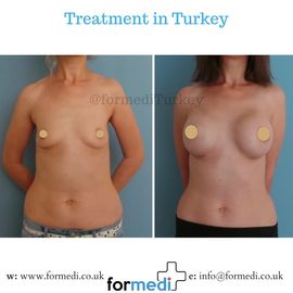 Breast Augmentation Turkiye