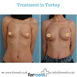 Breast Augmentation Turkiye
