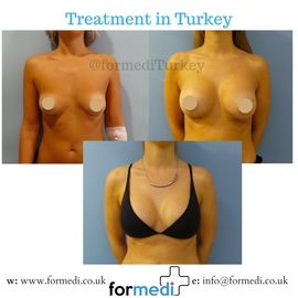 Breast Augmentation Turkiye