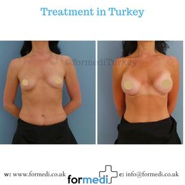 Breast Augmentation Turkiye