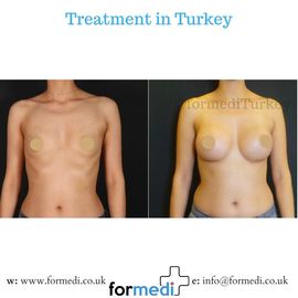 Breast Augmentation Turkiye