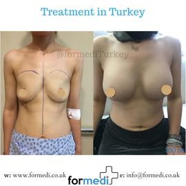 Breast Augmentation Turkiye