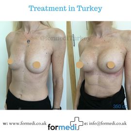 Breast Augmentation Turkiye