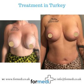 Breast Augmentation Turkiye
