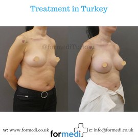 Breast Augmentation Turkiye