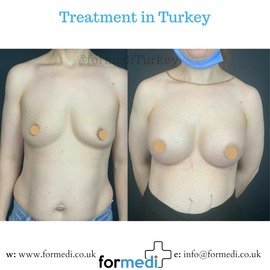 Breast Augmentation Turkiye