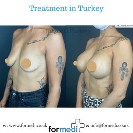 Breast Augmentation Turkiye