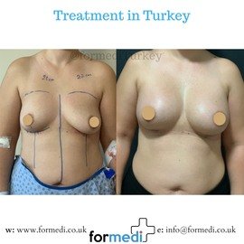 Breast Augmentation Turkiye
